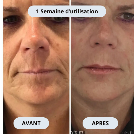 Sicelia Micro Infusion-System lévre
