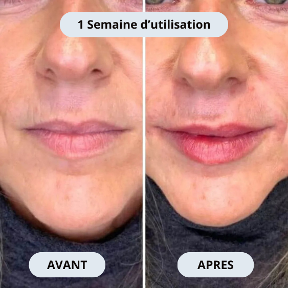 Sicelia Micro Infusion-System lévre