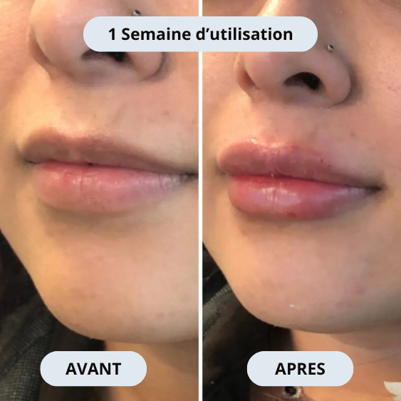 Sicelia Micro Infusion-System lévre