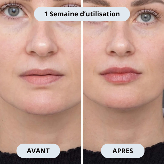 Sicelia Micro Infusion-System lévre